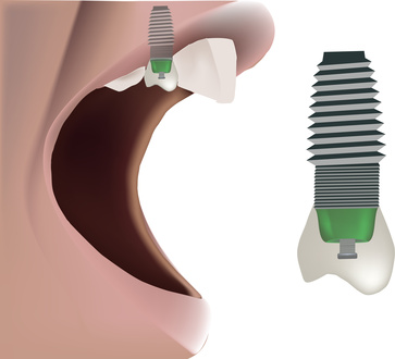 Implantate künstlich Zahnwurzel